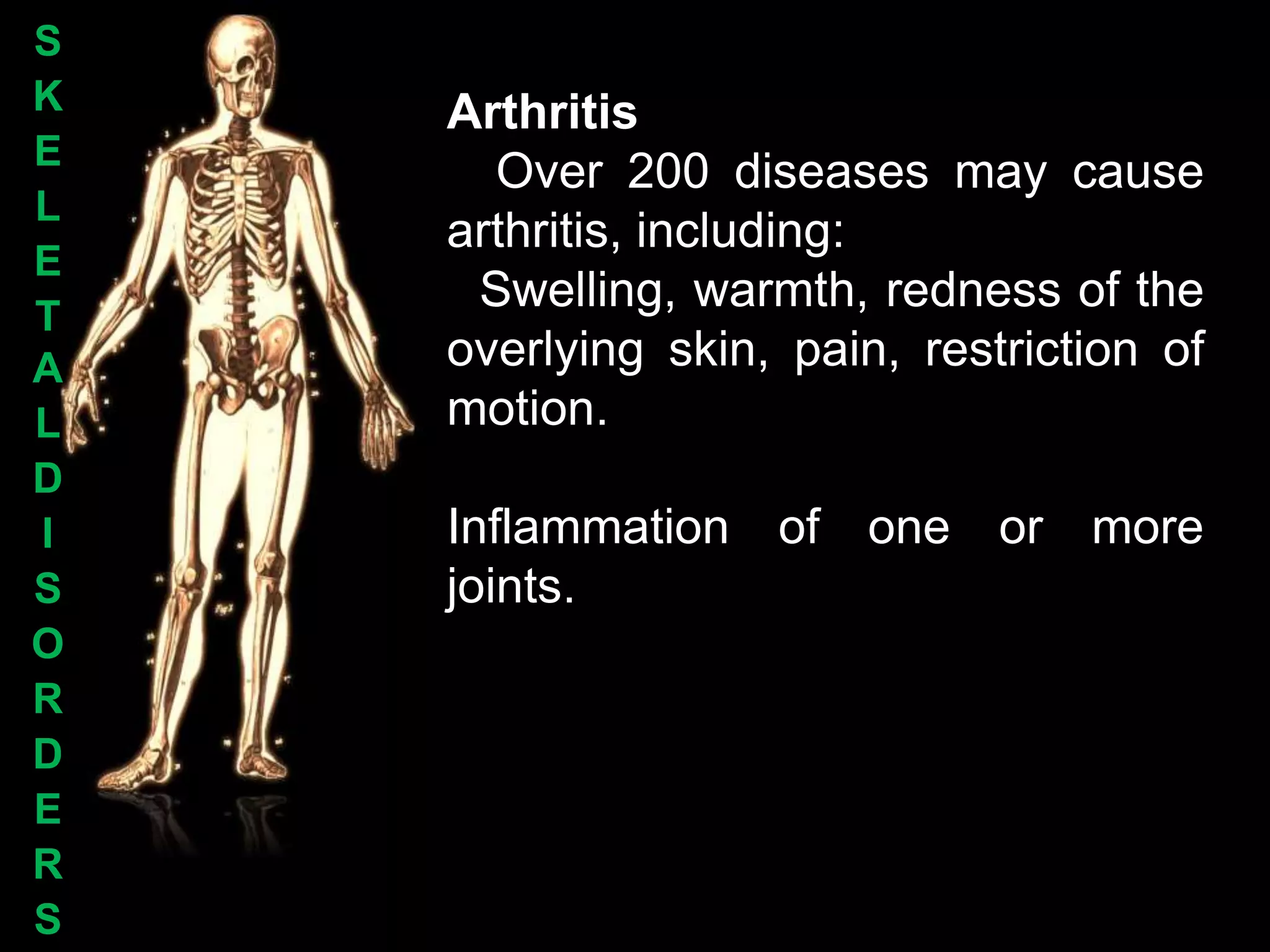 S
K   Arthritis
E
      Over 200 diseases may cause
L
    arthritis, including:
E
T
     Swelling, warmth, redness of the
A   overlying skin, pain, restriction of
L   motion.
D
I   Inflammation of one or more
S   joints.
O
R
D
E
R
S
 