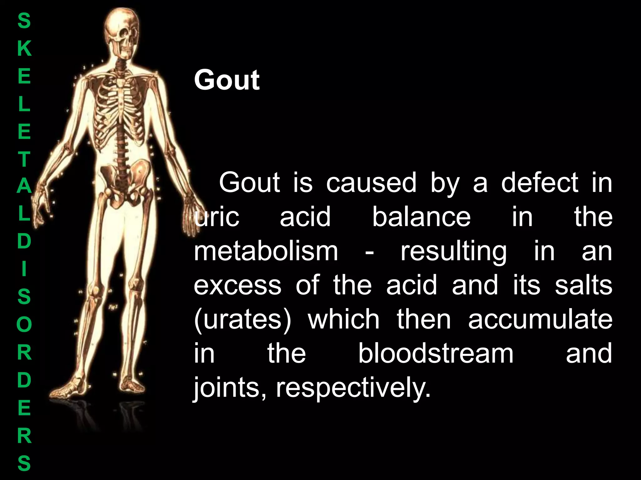 S
K
E   Gout
L
E
T
A      Gout is caused by a defect in
L   uric acid balance in the
D
    metabolism - resulting in an
I
S   excess of the acid and its salts
O   (urates) which then accumulate
R   in     the    bloodstream   and
D   joints, respectively.
E
R
S
 