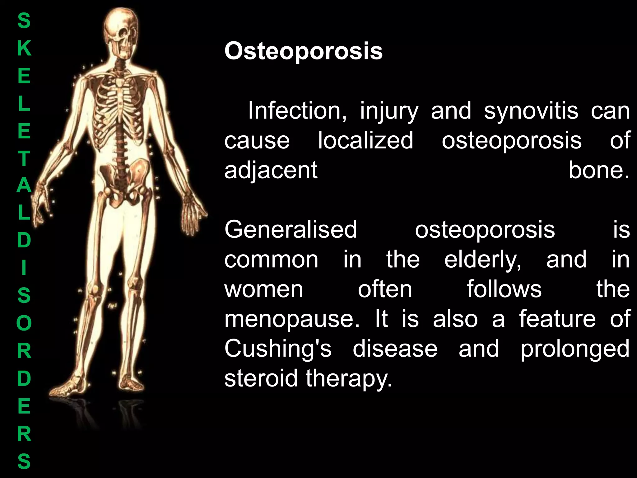 S
K   Osteoporosis
E
L     Infection, injury and synovitis can
E   cause localized osteoporosis of
T
    adjacent                        bone.
A
L
D   Generalised        osteoporosis   is
I   common in the elderly, and in
S   women        often     follows  the
O   menopause. It is also a feature of
R   Cushing's disease and prolonged
D   steroid therapy.
E
R
S
 