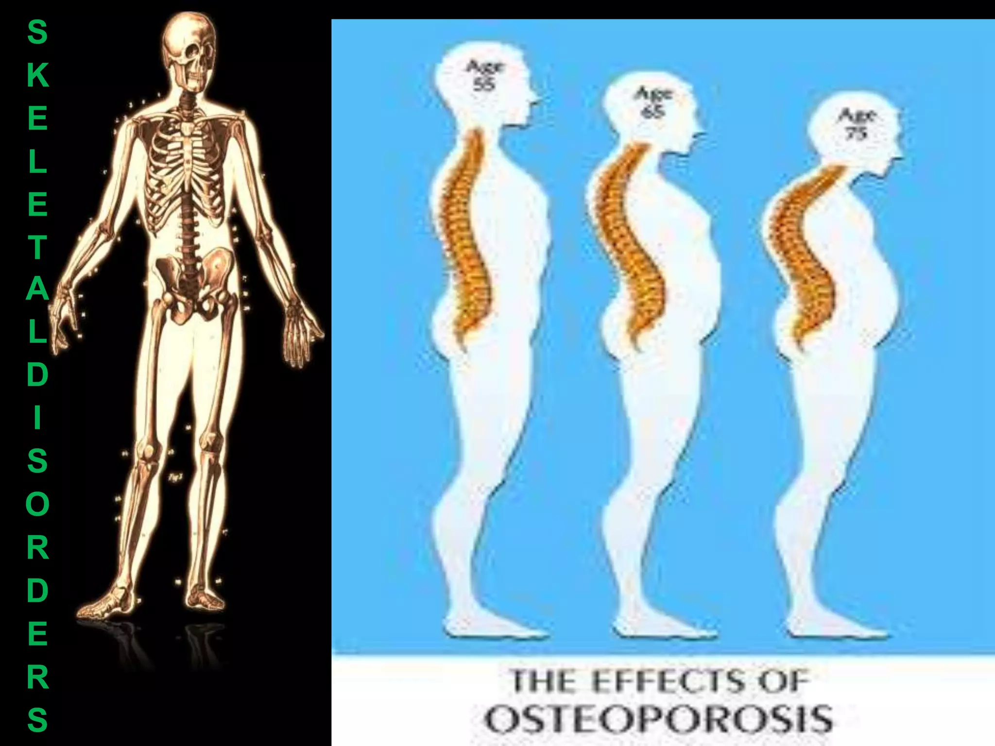 S
K
E
L
E
T
A
L
D
I
S
O
R
D
E
R
S
 