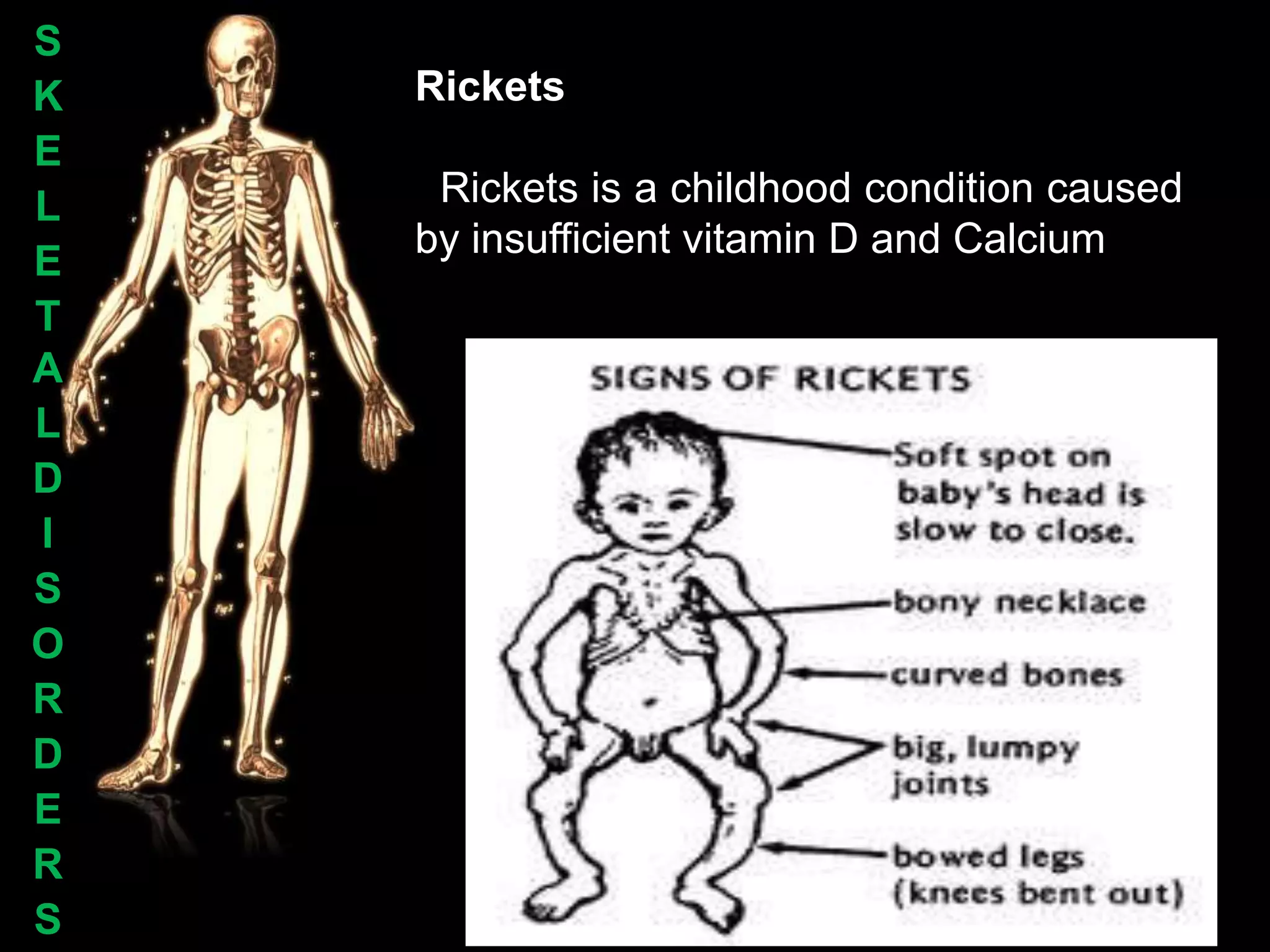 S
K   Rickets
E
L    Rickets is a childhood condition caused
    by insufficient vitamin D and Calcium
E
T
A
L
D
I
S
O
R
D
E
R
S
 