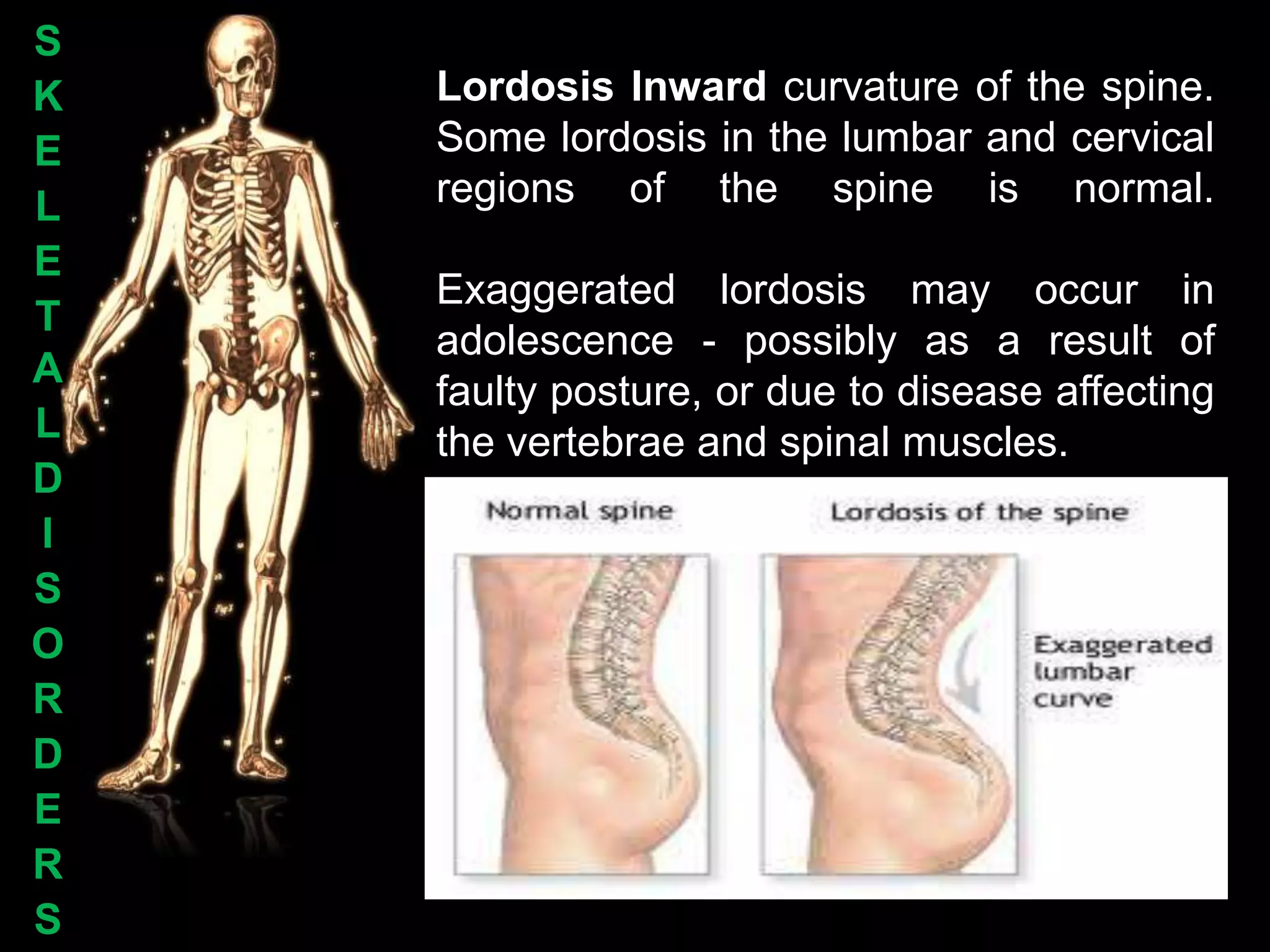 S
K   Lordosis Inward curvature of the spine.
E   Some lordosis in the lumbar and cervical
L   regions of the spine is normal.
E
    Exaggerated lordosis may occur in
T
    adolescence - possibly as a result of
A
    faulty posture, or due to disease affecting
L   the vertebrae and spinal muscles.
D
I
S
O
R
D
E
R
S
 