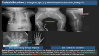 The Prototypes Ribs skeletal dysplasia-1.pptx presentation for students | PPTX