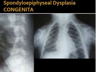Skeletal dysplasia