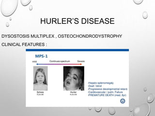 HURLER’S DISEASE
DYSOSTOSIS MULTIPLEX , OSTEOCHONDRODYSTROPHY
CLINICAL FEATURES :
 