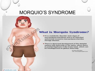 MORQUIO’S SYNDROME
 