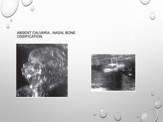 ABSENT CALVARIA , NASAL BONE
OSSIFICATION
 