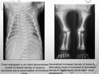 Chest radiograph in an infant demonstrates
overall increased density of osseous
structures due to accumulation of immature
Generalized increased density of bones &
alternating areas of increased & decreased
density in metaphyses (bone-within-bone
appearance).
 