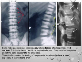 Spine radiographs reveal classic sandwich vertebrae of osteopetrosis (red
arrows). This is manifested as thickening and sclerosis of the vertebral endplates,
and of the bone adjacent to the endplates.
There is also marked thickening of the posterior vertebrae (yellow arrows),
especially in the vertebral arch.
 
