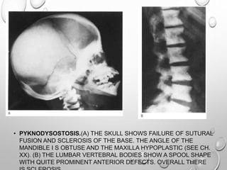 • PYKNODYSOSTOSIS.(A) THE SKULL SHOWS FAILURE OF SUTURAL
FUSION AND SCLEROSIS OF THE BASE. THE ANGLE OF THE
MANDIBLE I S OBTUSE AND THE MAXILLA HYPOPLASTIC (SEE CH.
XX). (B) THE LUMBAR VERTEBRAL BODIES SHOW A SPOOL SHAPE
WITH QUITE PROMINENT ANTERIOR DEFECTS. OVERALL THERE
 