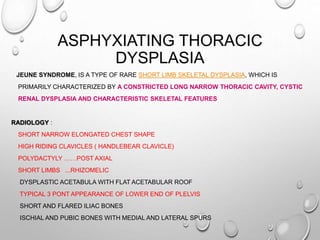 ASPHYXIATING THORACIC
DYSPLASIA
JEUNE SYNDROME, IS A TYPE OF RARE SHORT LIMB SKELETAL DYSPLASIA, WHICH IS
PRIMARILY CHARACTERIZED BY A CONSTRICTED LONG NARROW THORACIC CAVITY, CYSTIC
RENAL DYSPLASIA AND CHARACTERISTIC SKELETAL FEATURES
RADIOLOGY :
SHORT NARROW ELONGATED CHEST SHAPE
HIGH RIDING CLAVICLES ( HANDLEBEAR CLAVICLE)
POLYDACTYLY ……POST AXIAL
SHORT LIMBS ...RHIZOMELIC
DYSPLASTIC ACETABULA WITH FLAT ACETABULAR ROOF
TYPICAL 3 PONT APPEARANCE OF LOWER END OF PLELVIS
SHORT AND FLARED ILIAC BONES
ISCHIAL AND PUBIC BONES WITH MEDIAL AND LATERAL SPURS
 