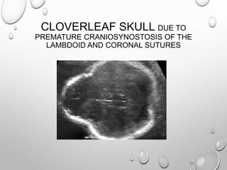 CLOVERLEAF SKULL DUE TO
PREMATURE CRANIOSYNOSTOSIS OF THE
LAMBDOID AND CORONAL SUTURES
 