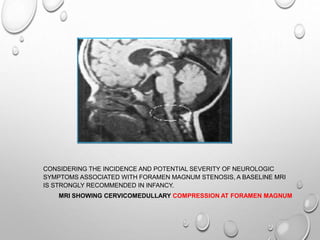 CONSIDERING THE INCIDENCE AND POTENTIAL SEVERITY OF NEUROLOGIC
SYMPTOMS ASSOCIATED WITH FORAMEN MAGNUM STENOSIS, A BASELINE MRI
IS STRONGLY RECOMMENDED IN INFANCY.
MRI SHOWING CERVICOMEDULLARY COMPRESSION AT FORAMEN MAGNUM
 