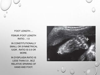 FOOT LENGTH….
FEMUR /FOOT LENGTH
RATIO…1.0
IN CONSTITUTIONALLY
SMALL OR SYMMETRICAL
IUGR , RATIO IS 0.9 OR
MORE.
IN DYSPLASIA RATIO IS
LESS THAN 0.9 , BCZ
RELATIVE SPARING OF
HAND AND FOOT.
 