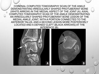 CORONAL COMPUTED TOMOGRAPHY SCAN OF THE ANKLE
DEMONSTRATING IRREGULARLY SHAPED PROTUBERANT BONE
(WHITE ARROW) IN THE MEDIAL ASPECT OF THE JOINT (A). AXIAL
COMPUTED TOMOGRAPHY SCAN OF THE ANKLE DEMONSTRATING
AN IRREGULARLY SHAPED PROTUBERANT BONE LESION OF THE
MEDIAL ANKLE JOINT, WITH A PORTION CONNECTED TO THE
ANTERIOR TALUS, AND A SECOND LESION MORE POSTERIORLY
LOCATED AND A DEFINED CLEFT (BLACK ARROWS) AT THE
INTERFACE (B).
 