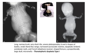 skeletal dysplasia musculoskeletal imaging | PPTX