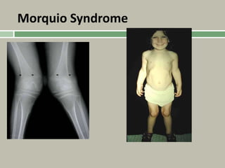 Morquio Syndrome
 