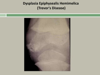 Dysplasia Epiphysealis Hemimelica
(Trevor's Disease)
 