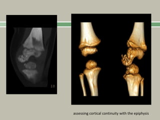 assessing cortical continuity with the epiphysis
 