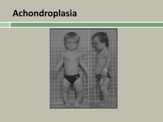 Achondroplasia
 