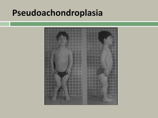 Pseudoachondroplasia
 