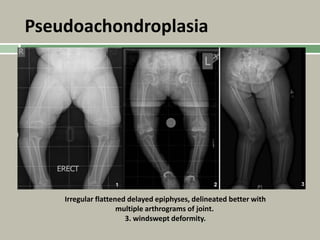 Pseudoachondroplasia
Irregular flattened delayed epiphyses, delineated better with
multiple arthrograms of joint.
3. windswept deformity.
 