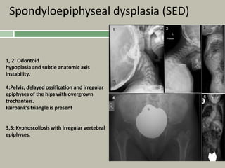 Spondyloepiphyseal dysplasia (SED)
1, 2: Odontoid
hypoplasia and subtle anatomic axis
instability.
4:Pelvis, delayed ossification and irregular
epiphyses of the hips with overgrown
trochanters.
Fairbank’s triangle is present
3,5: Kyphoscoliosis with irregular vertebral
epiphyses.
 