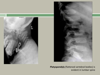 Platyspondyly (flattened vertebral bodies) is
evident in lumbar spine
 