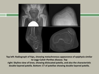 Top left: Radiograph of hips, showing metachronous appearance of epiphysis similar
to Legg–Calvé–Perthes disease. Top
right: Skyline view of knee, showing dislocated patella, and also the characteristic
double-layered patella. Bottom: CT of patellae showing double-layered patella.
 