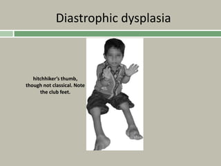 Diastrophic dysplasia
hitchhiker’s thumb,
though not classical. Note
the club feet.
 