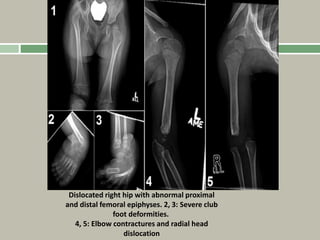 Dislocated right hip with abnormal proximal
and distal femoral epiphyses. 2, 3: Severe club
foot deformities.
4, 5: Elbow contractures and radial head
dislocation
 