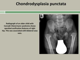 Chondrodysplasia punctata
Radiograph of an older child with
Conradi–Hünermann syndrome shows
speckled ossification features of right
hip. This was associated with bilateral coxa
vara.
 