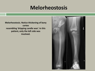 Melorheostosis
Melorheostosis. Notice thickening of bony
cortex
resembling ‘dripping candle wax’. In this
patient, only the left side was
involved.
 