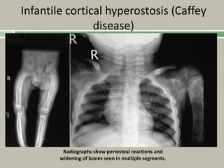 Infantile cortical hyperostosis (Caffey
disease)
Radiographs show periosteal reactions and
widening of bones seen in multiple segments.
 