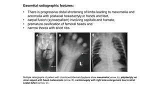 Essential radiographic features:
• There is progressive distal shortening of limbs leading to mesomelia and
acromelia with postaxial hexadactyly in hands and feet,
• carpal fusion (syncarpalism) involving capitate and hamate,
• premature ossification of femoral heads and
• narrow thorax with short ribs.
Multiple radiographs of patient with chondroectodermal dysplasia show mesomelia (arrow, A), polydactyly on
ulnar aspect with fused metacarpals (arrow, B), cardiomegaly with right side enlargement due to atrial
septal defect (arrow, C).
 
