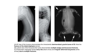 (A) AP view of the humerus demonstrates the characteristic demineralized, gracile bones of OI. Note the
fracture of the distal diaphysis (arrow).
(B) Lateral view of the thoracolumbar spine demonstrates multiple wedge and biconcave fractures.
(C) Postmortem radiograph shows wavy ribs (black arrow) and irregular deformed long bones (white
arrows) due to multiple fractures.
 