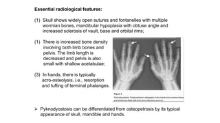 Essential radiological features:
(1) Skull shows widely open sutures and fontanelles with multiple
wormian bones, mandibular hypoplasia with obtuse angle and
increased sclerosis of vault, base and orbital rims;
(1) There is increased bone density
involving both limb bones and
pelvis. The limb length is
decreased and pelvis is also
small with shallow acetabulae;
(3) In hands, there is typically
acro-osteolysis, i.e., resorption
and tufting of terminal phalanges.
⮚ Pyknodyostosis can be differentiated from osteopetrosis by its typical
appearance of skull, mandible and hands.
 