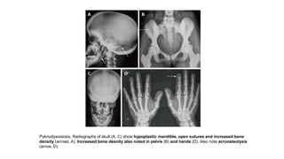 Pyknodysostosis. Radiographs of skull (A, C) show hypoplastic mandible, open sutures and increased bone
density (arrows, A). Increased bone desnity also noted in pelvis (B) and hands (D). Also note acroosteolysis
(arrow, D).
 