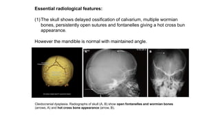 Essential radiological features:
(1)The skull shows delayed ossification of calvarium, multiple wormian
bones, persistently open sutures and fontanelles giving a hot cross bun
appearance.
However the mandible is normal with maintained angle.
Cleidocranial dysplasia. Radiographs of skull (A, B) show open fontanelles and wormian bones
(arrows, A) and hot cross bone appearance (arrow, B).
 