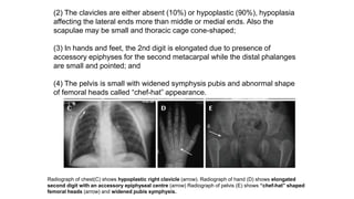 Radiograph of chest(C) shows hypoplastic right clavicle (arrow). Radiograph of hand (D) shows elongated
second digit with an accessory epiphyseal centre (arrow) Radiograph of pelvis (E) shows “chef-hat” shaped
femoral heads (arrow) and widened pubis symphysis.
(2) The clavicles are either absent (10%) or hypoplastic (90%), hypoplasia
affecting the lateral ends more than middle or medial ends. Also the
scapulae may be small and thoracic cage cone-shaped;
(3) In hands and feet, the 2nd digit is elongated due to presence of
accessory epiphyses for the second metacarpal while the distal phalanges
are small and pointed; and
(4) The pelvis is small with widened symphysis pubis and abnormal shape
of femoral heads called “chef-hat” appearance.
 
