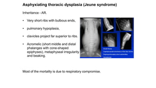 Asphyxiating thoracic dysplasia (Jeune syndrome)
Inheritance - AR.
• Very short ribs with bulbous ends,
• pulmonary hypoplasia,
• clavicles project far superior to ribs.
• Acromelic (short middle and distal
phalanges with cone-shaped
epiphyses), metaphyseal irregularity
and beaking.
Most of the mortality is due to respiratory compromise.
 