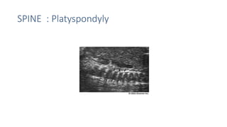 SPINE : Platyspondyly
 