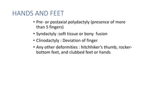 HANDS AND FEET
• Pre- or postaxial polydactyly (presence of more
than 5 fingers)
• Syndactyly :soft tissue or bony fusion
• Clinodactyly : Deviation of finger
• Any other deformities : hitchhiker’s thumb, rocker-
bottom feet, and clubbed feet or hands
 