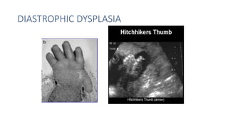 DIASTROPHIC DYSPLASIA
 