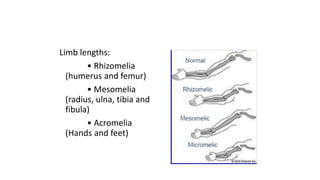 Limb lengths:
• Rhizomelia
(humerus and femur)
• Mesomelia
(radius, ulna, tibia and
fibula)
• Acromelia
(Hands and feet)
 