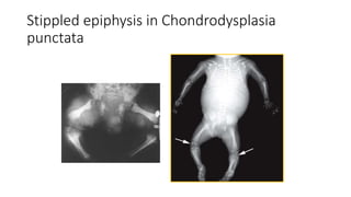 Stippled epiphysis in Chondrodysplasia
punctata
 