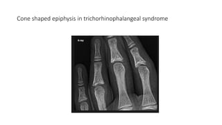 Cone shaped epiphysis in trichorhinophalangeal syndrome
 