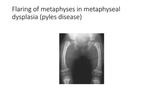 Flaring of metaphyses in metaphyseal
dysplasia (pyles disease)
 