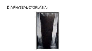 DIAPHYSEAL DYSPLASIA
 