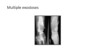 Multiple exostoses
 